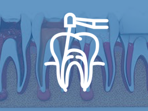 Endodontik (Kanal Tedavisi)